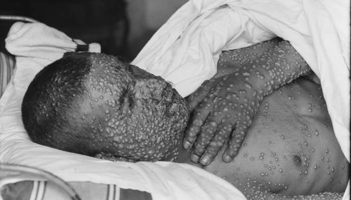 Smallpox victim.