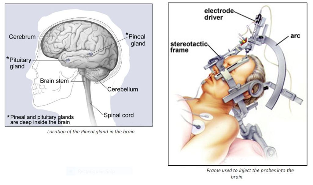 This is how the procedure was implemented. Scaffolding setup