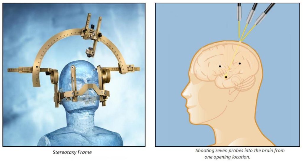 The Stereotaxy frame was much larger than what is pictured in this illustration. Two men were needed to carry it into the probe implantation chamber. Injection Procedure